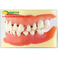 EN-L4 Peridontal Disease Dental Model with Removable Soft Gingival